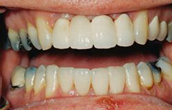Tooth decay treatments by Wilmington dentists at Wahl Family Dentistry