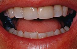 Chipped tooth repair in Wilmington, DE